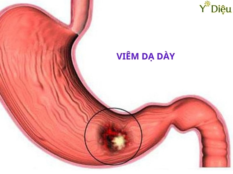 Viêm Loét Dạ Dày Tá Tràng: Nguyên Nhân Và Cách Điều Trị